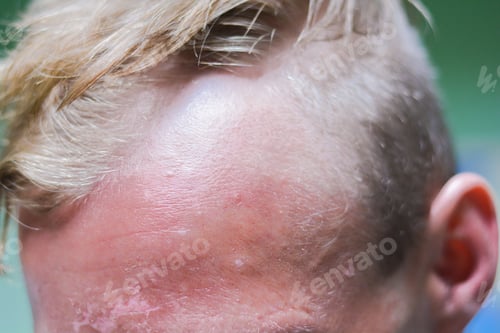 Preview: Burnt Face Of Young Caucasian Man.