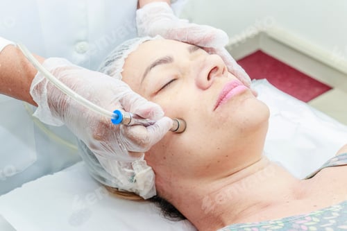 Preview: The Cosmetologist Does The Procedure Microdermabrasion Of The Facial Skin Of A Real Woman