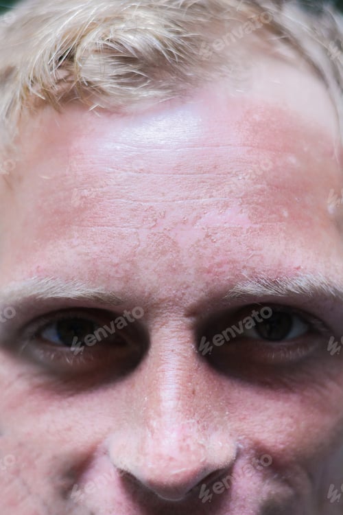 Preview: Burnt Face Of Young Caucasian Man.