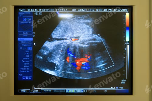 Preview: Close Up Of An Ultrasound Image Of A Pregnancy Being Displayed On A Monitor.
