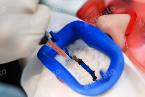 Preview: There Is A Preparation Of The Oral Cavity To Bleaching With The Help Of An Ultraviolet Lamp