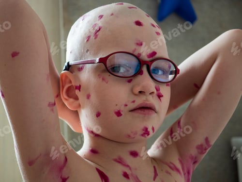 Preview: Upset Blond Child In Pink Glasses Front Of Mirror Has Chickenpox. Mother Smeared Follicles With