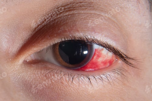 Preview: Hemorrhage In The Eye Of A Woman. Bruising Of The Cornea. Macro.