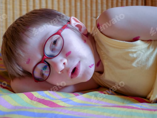 Preview: Blond Child Has Chickenpox. Mother Smeared Follicles With Takkelani Pink Solution All Over Her
