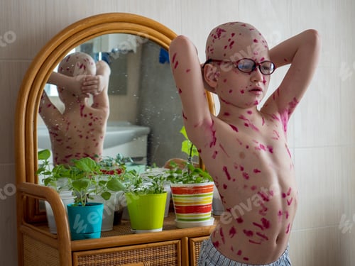 Preview: Upset Blond Child In Pink Glasses Front Of Mirror Has Chickenpox. Mother Smeared Follicles With