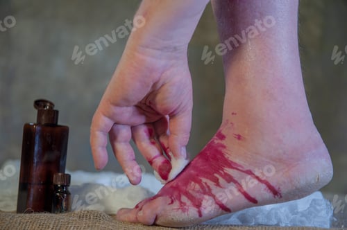 Preview: An Elderly Man With Bare Legs Draws An Iodine Grid At The Site Of A Tumor And A Bruise On His Leg