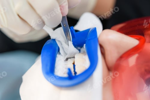 Preview: There Is A Preparation Of The Oral Cavity To Bleaching With The Help Of An Ultraviolet Lamp