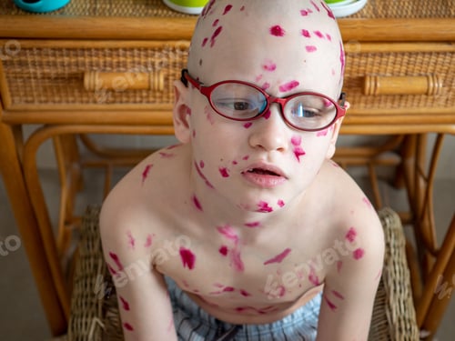 Preview: Upset Blond Child In Pink Glasses Front Of Mirror Has Chickenpox. Mother Smeared Follicles With