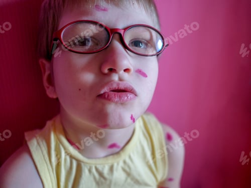 Preview: Blond Child In Glasses Has Chickenpox. Mother Smeared Follicles With Takkelani Pink Solution All