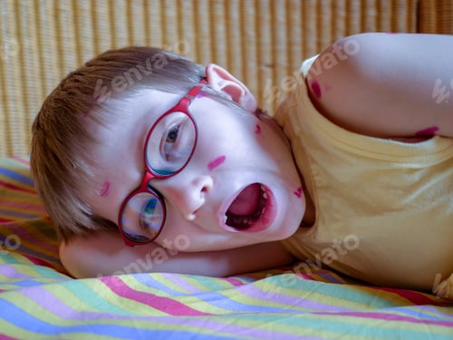 Preview: Blond Child Has Chickenpox. Mother Smeared Follicles With Takkelani Pink Solution All Over Her