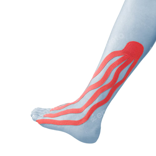 Preview: Ankle Pain With Therapy Tape Treatment