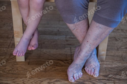 Preview: Elderly Woman With Sore Legs Is Sitting On Chair And Preparing For Medical Procedures. Feet With