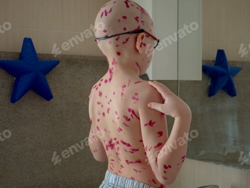 Preview: Upset Blond Child In Pink Glasses Front Of Mirror Has Chickenpox. Mother Smeared Follicles With
