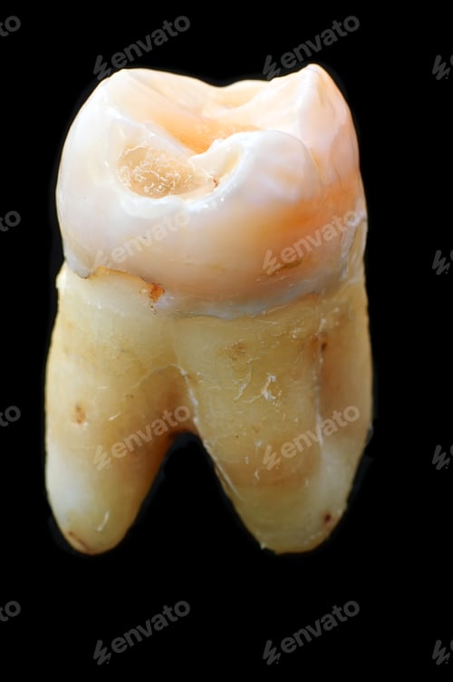 Preview: This Is An Upper Side View Of My Wisdom Tooth That Had To Be Extracted Due To A Massive Cavity