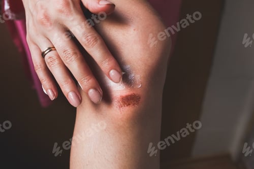 Preview: Abrasion On The Woman'S Knee. Girl Is Applying Cream On The Injured Leg With A Red Wound. Medical