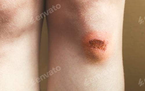 Preview: Abrasion On The Woman'S Knee. Injured Leg With A Red Wound. Medical Treatment For First Aid.