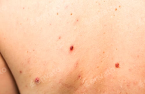 Preview: Many Birthmarks On The Girl'S Back. Medical Health Photo. Woman'S Oily Skin With Problems Acne.