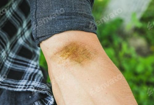 Preview: Old Scar On Man'S Arm. Accident In The Past.