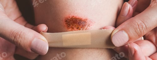 Preview: Abrasion On The Woman'S Knee. Girl Is Applying Antiseptic Band-Aid Plaster On The Injured Leg With