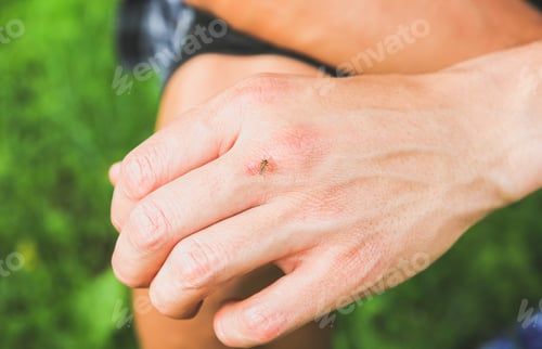 Preview: Mosquito Sitting On The Hand. Insects Bite In The Summer. Dangerous Nature. Itchy Body.