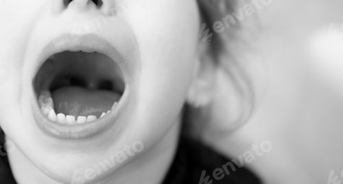 Preview: Close Up Portrait Of A Little Girl Screaming In Balck And White. Dental Healthcare. Copy Space For