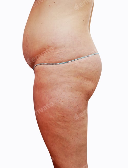 Visualização: Mulheres indispostas com celulite em um branco