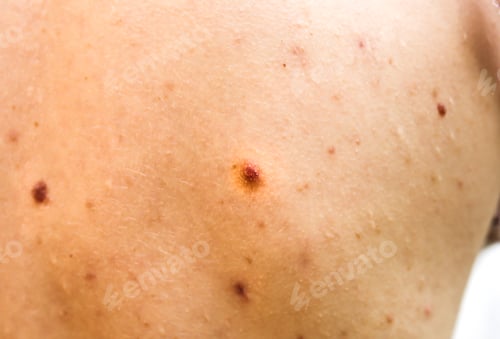 Preview: Many Birthmarks On The Girl'S Back. Medical Health Photo. Woman'S Oily Skin With Problems Acne.