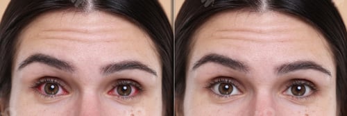 Preview: Before and after conjunctivitis treatment. Photos of woman with red and healthy eyes, collage