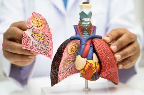 Preview: Pneumonia, lung cancer, Asian doctor holding human anatomy