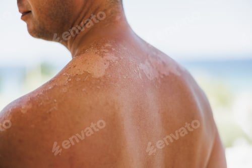 Preview: Close-up Of A Red Shoulder And Back Of A Man With A Sunburned Skin