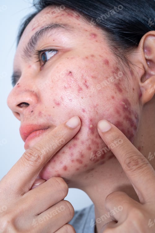 Preview: Acne on face because the disorders of sebaceous glands productions. Acne or a Cosmetic Allergy.