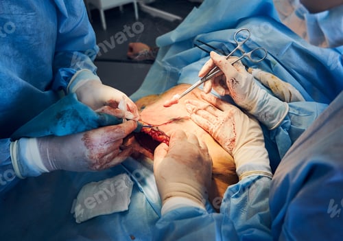 Vista previa: Médico y asistente que realizan abdominoplastia o cirugía de abdominoplastia.