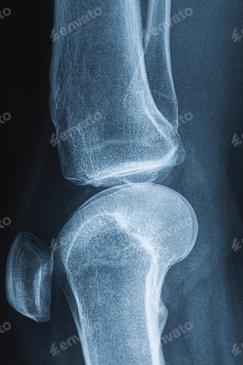 Preview: X-ray image of human knee