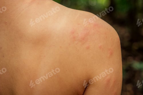 Preview: Woman with itching from biting insect in body in tropical jungle forest