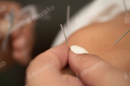 Preview: Acupuncture for Shoulder Pain