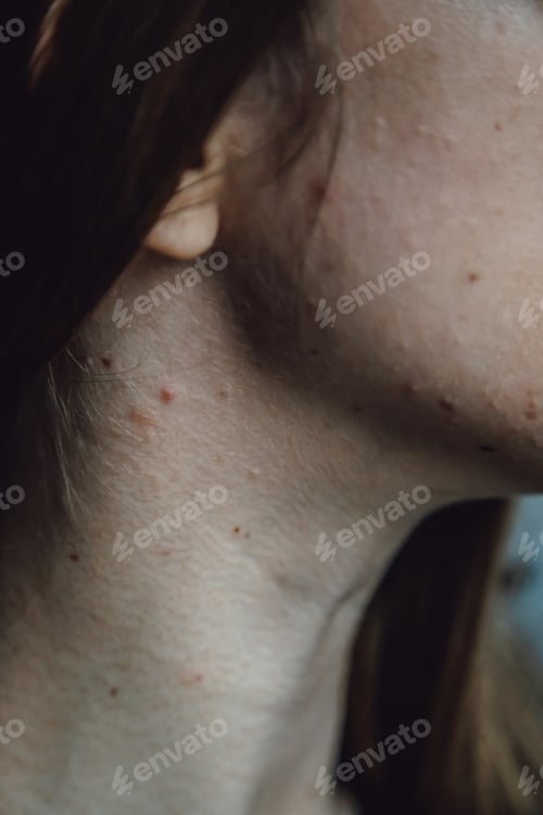 Preview: Close up of young woman having acne and pimples on unhealthy skin. Anxious woman worried about