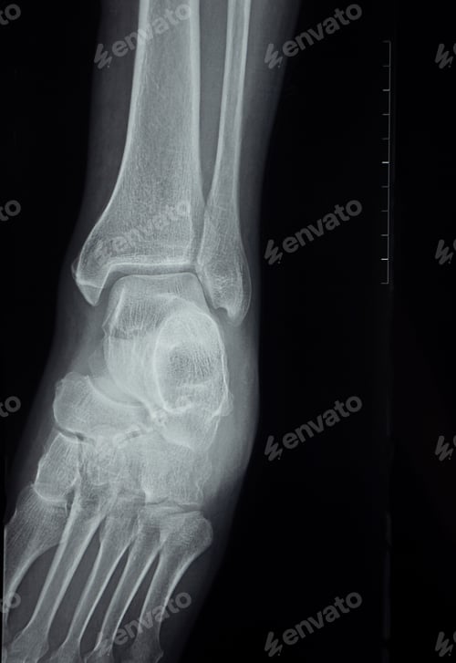 Preview: A close-up x-ray of the sole of the human foot
