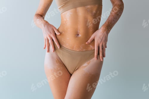 Preview: partial view of young woman with vitiligo standing in underwear isolated on grey