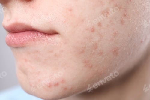 Preview: Young man with acne problem on grey background, closeup