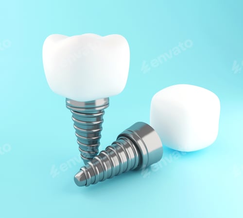 Preview: 3d Dental tooth implant.