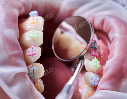 Preview: Dental procedure, process of checking white ceramic braces with a help of dental mirror