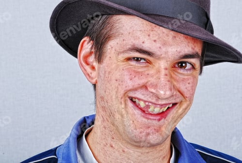Preview: Young Funny Man With Many Acne On Face Smiling