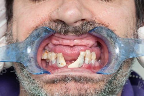 Preview: Rotten teeth during inspection with retractor for dental implant design.