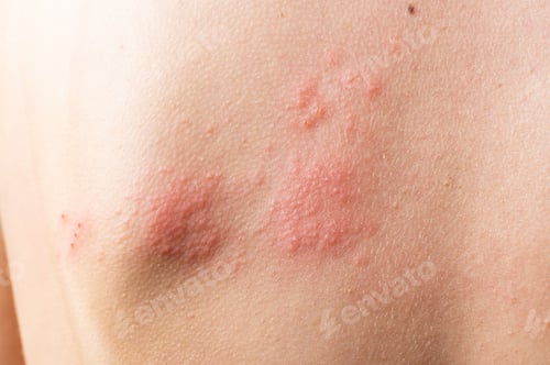 Preview: Skin infected Herpes zoster virus. Herpes Virus on body. urticaria rash