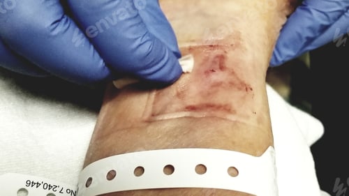 Preview: Angiogram! Wrist Wound Care! Healthcare and Medicine!