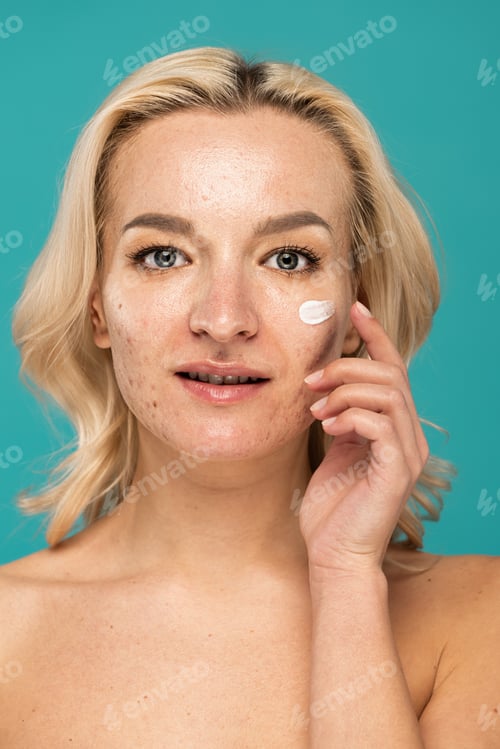 Preview: blonde woman with acne applying cream on face isolated on turquoise