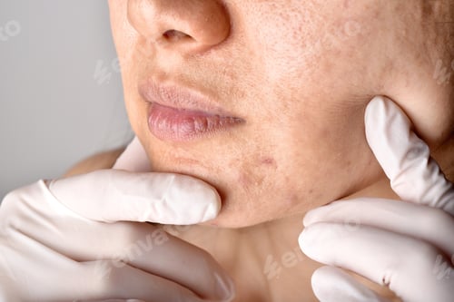 Preview: Doctor or Dermatologist hand exam patient face