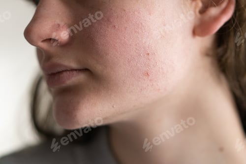 Preview: Problem skin face. A teenage girl with a troubled face.