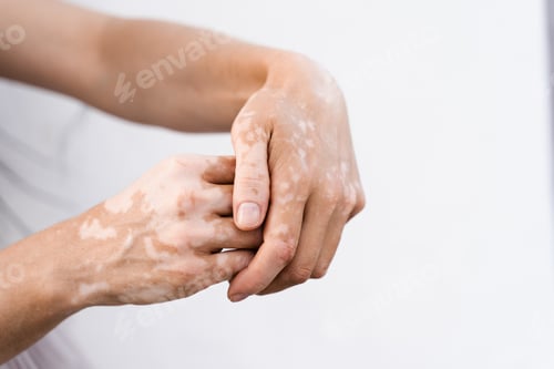 Preview: White background close-up of vitiligo hands, lifestyle and seasonal skin awareness.
