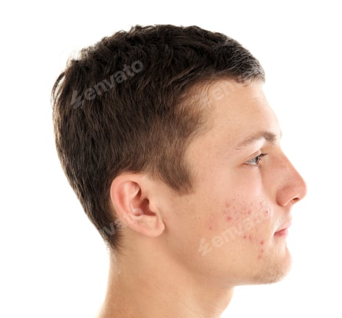 Preview: Young man with acne problem on white background